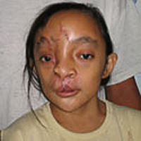 charlene-nachher-operationrestore-hope.png