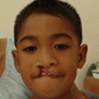 edilberto-vorher-operationrestore-hope.png