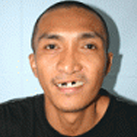 reynaldo-nachher-operationrestore-hope.png